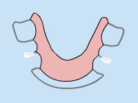 braces loose appliance