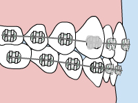 braces loose bracket