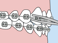 braces loose wire