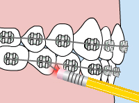braces poking wire